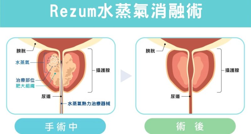 攝護腺肥大微創治療的新時代   Rezum水蒸氣消融與雷射攝護腺手術